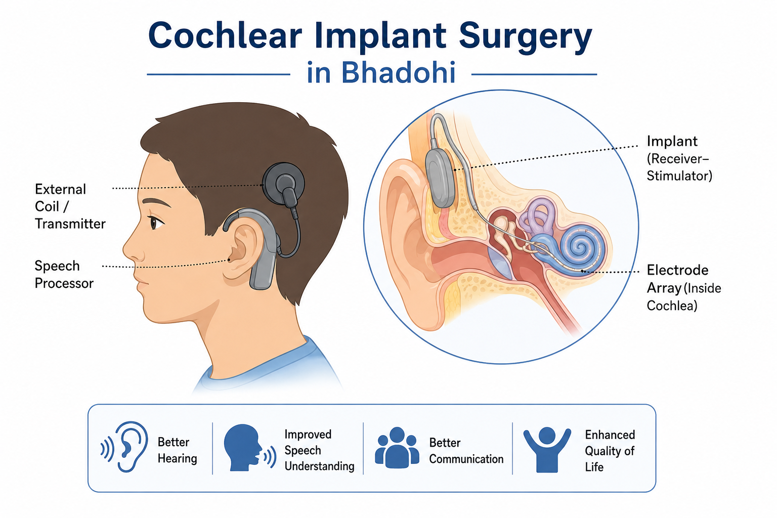 This comprehensive guide covers everything you need to know about cochlear implant surgery in Bhadohi, including its benefits, eligibility, procedure, recovery, costs, and long-term outcomes.